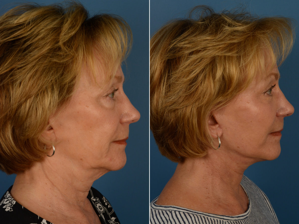 Fat Transfer Before and After Photos in Naples, FL, Patient 14406
