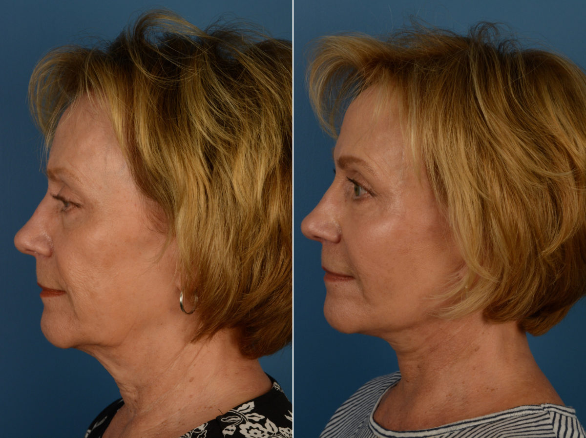 Fat Transfer Before and After Photos in Naples, FL, Patient 14406
