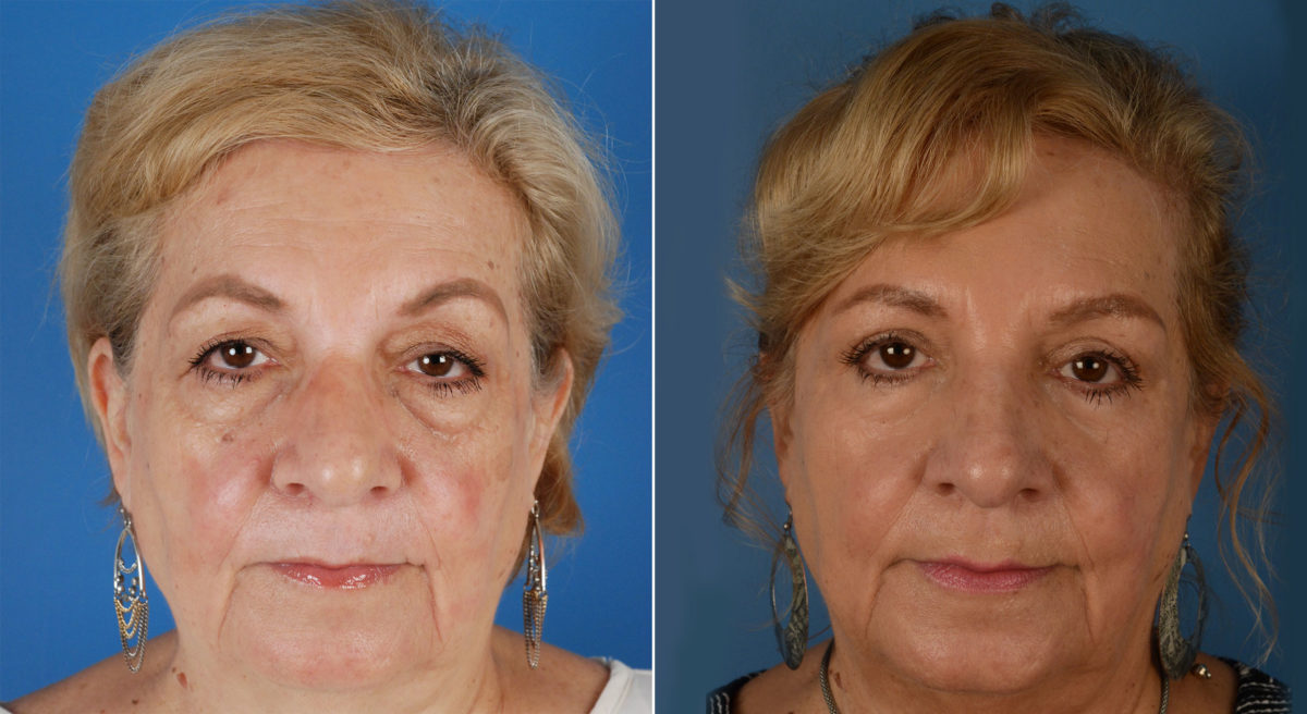 Blepharoplasty Before and After Photos in Naples, FL, Patient 11550