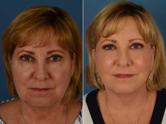 The UpLift™ Lower Face and Neck Lift Before and After Photos in Naples, FL, Patient 14428