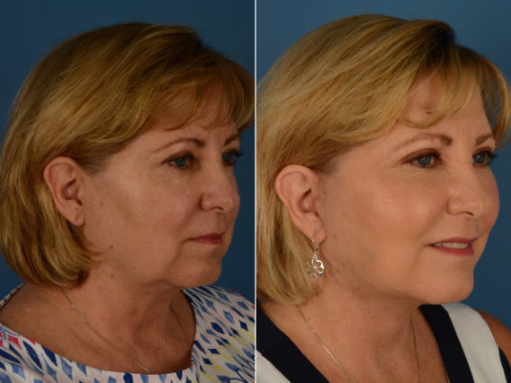 The UpLift™ Lower Face and Neck Lift Before and After Photos in Naples, FL, Patient 14428