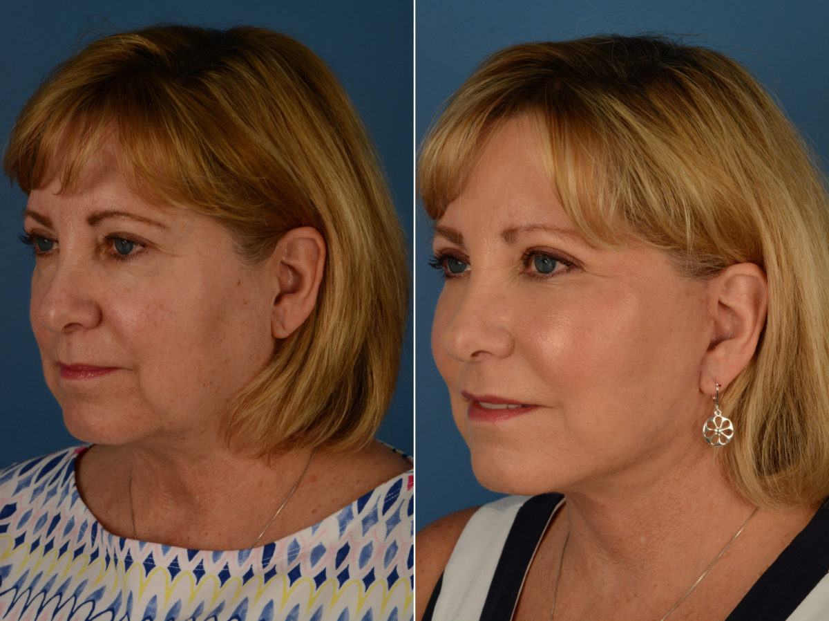The UpLift™ Lower Face and Neck Lift Before and After Photos in Naples, FL, Patient 14428