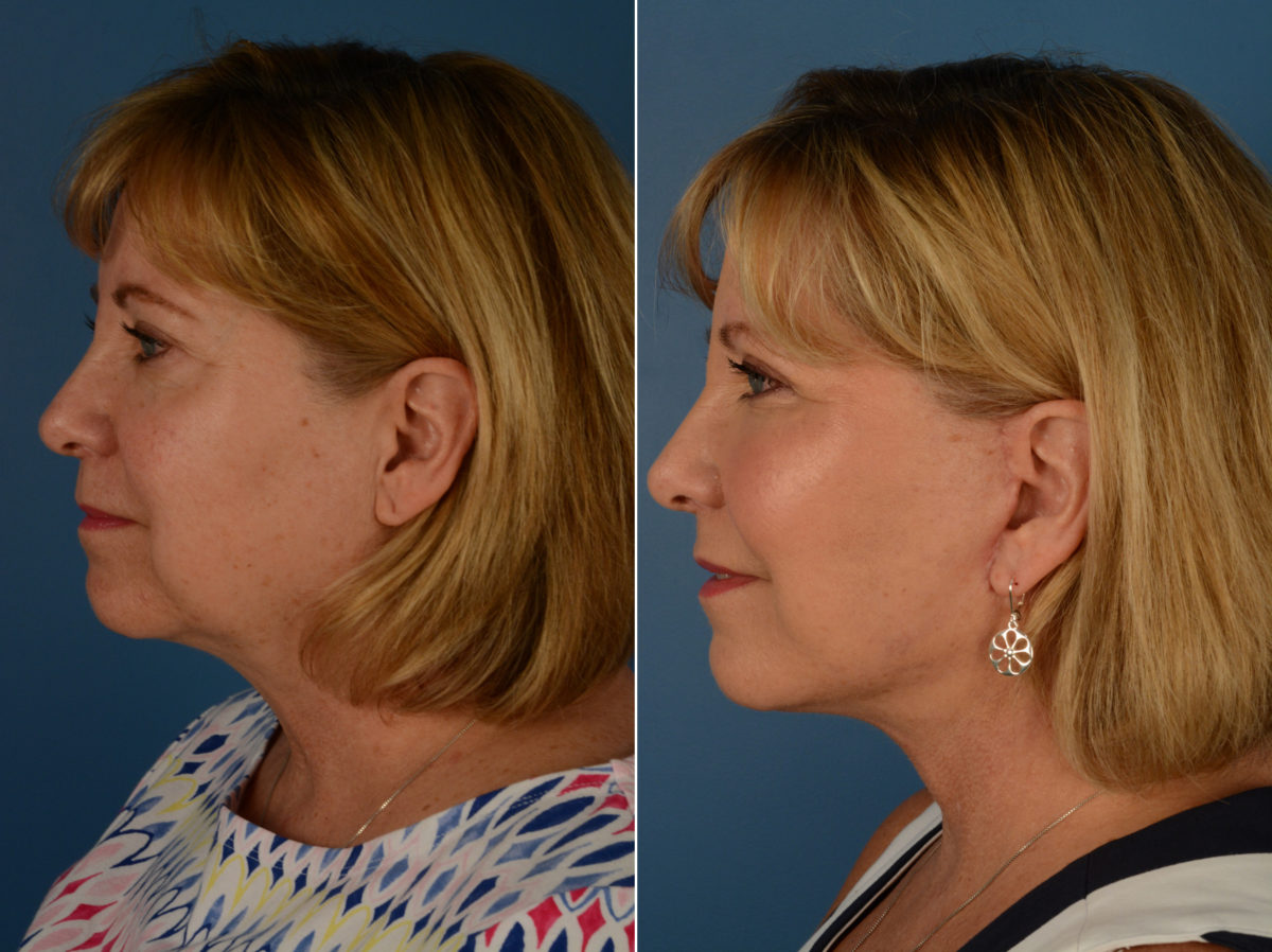 The UpLift™ Lower Face and Neck Lift Before and After Photos in Naples, FL, Patient 14428