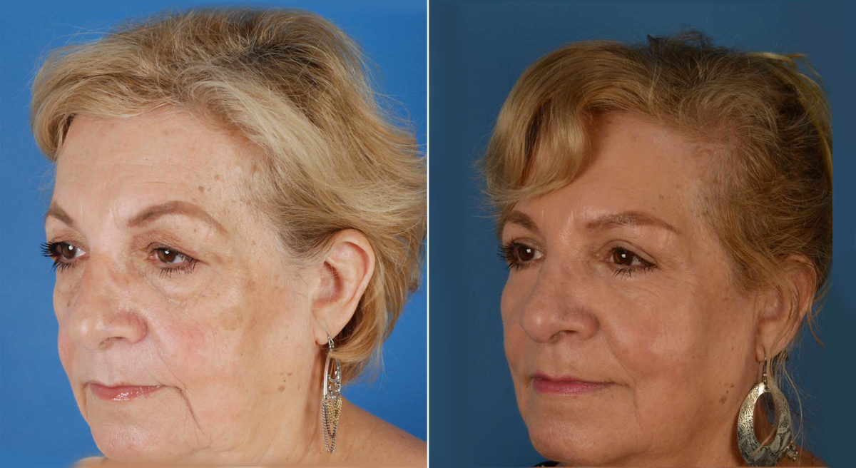 Blepharoplasty Before and After Photos in Naples, FL, Patient 11550