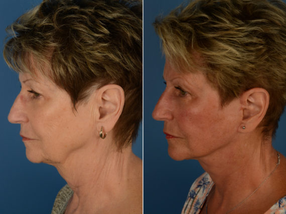 The UpLift™ Lower Face and Neck Lift Before and After Photos in Naples, FL, Patient 14461