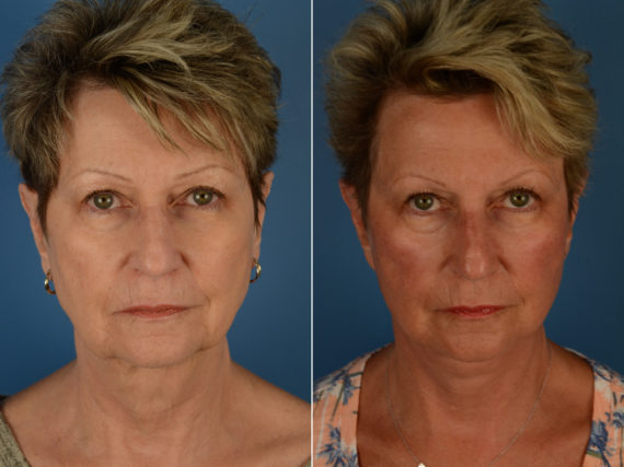 The UpLift™ Lower Face and Neck Lift Before and After Photos in Naples, FL, Patient 14461