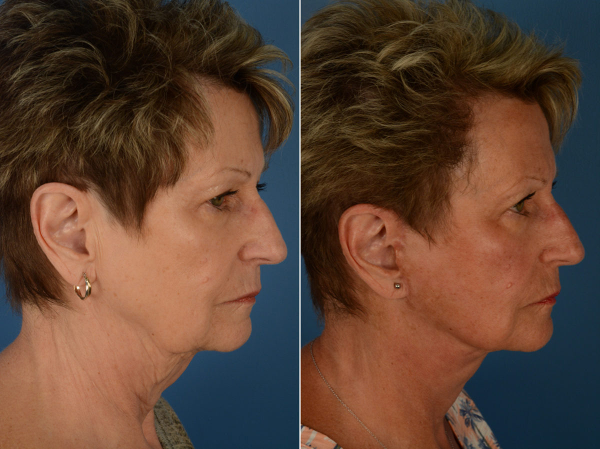 The UpLift™ Lower Face and Neck Lift Before and After Photos in Naples, FL, Patient 14461