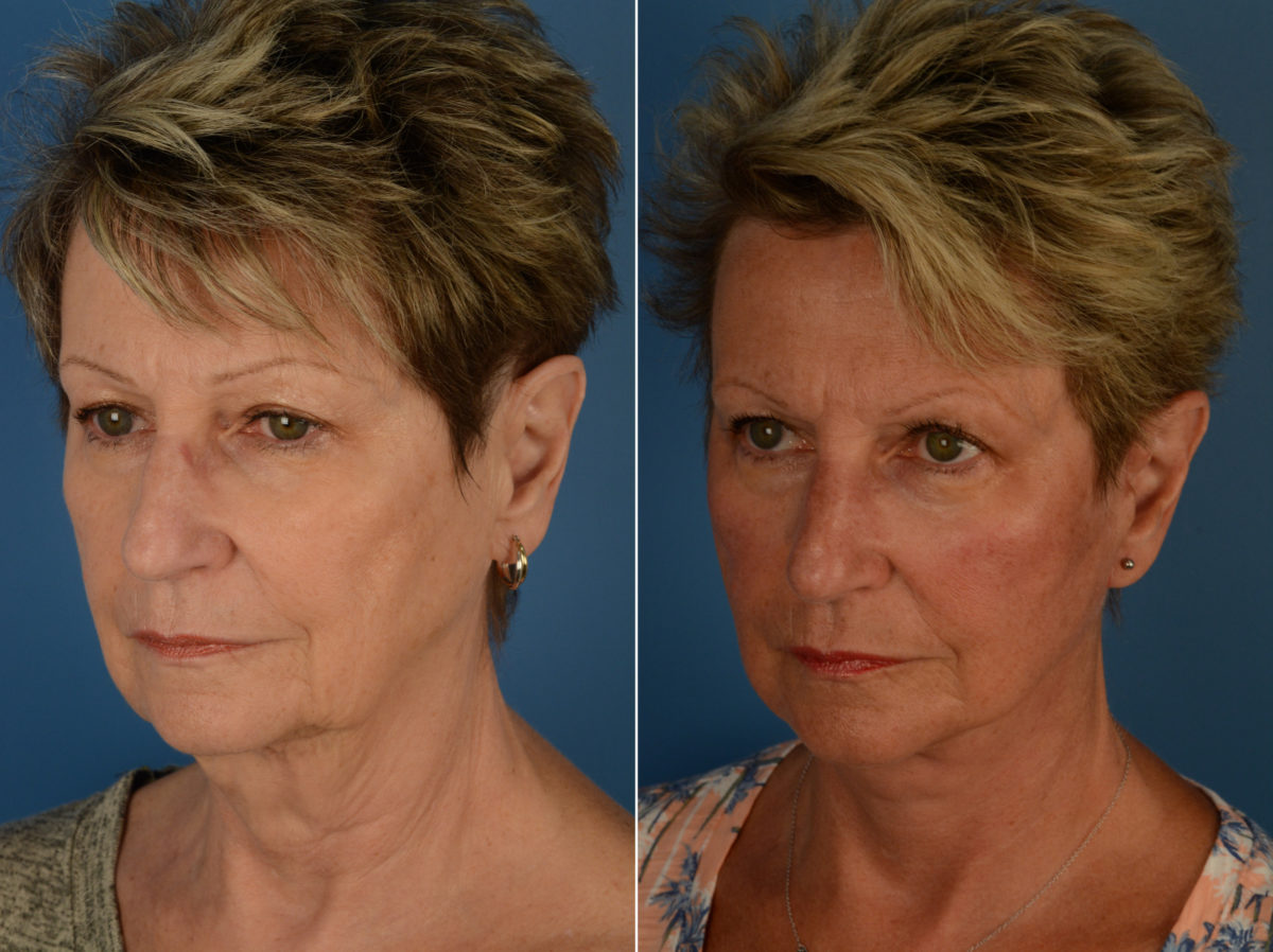The UpLift™ Lower Face and Neck Lift Before and After Photos in Naples, FL, Patient 14461