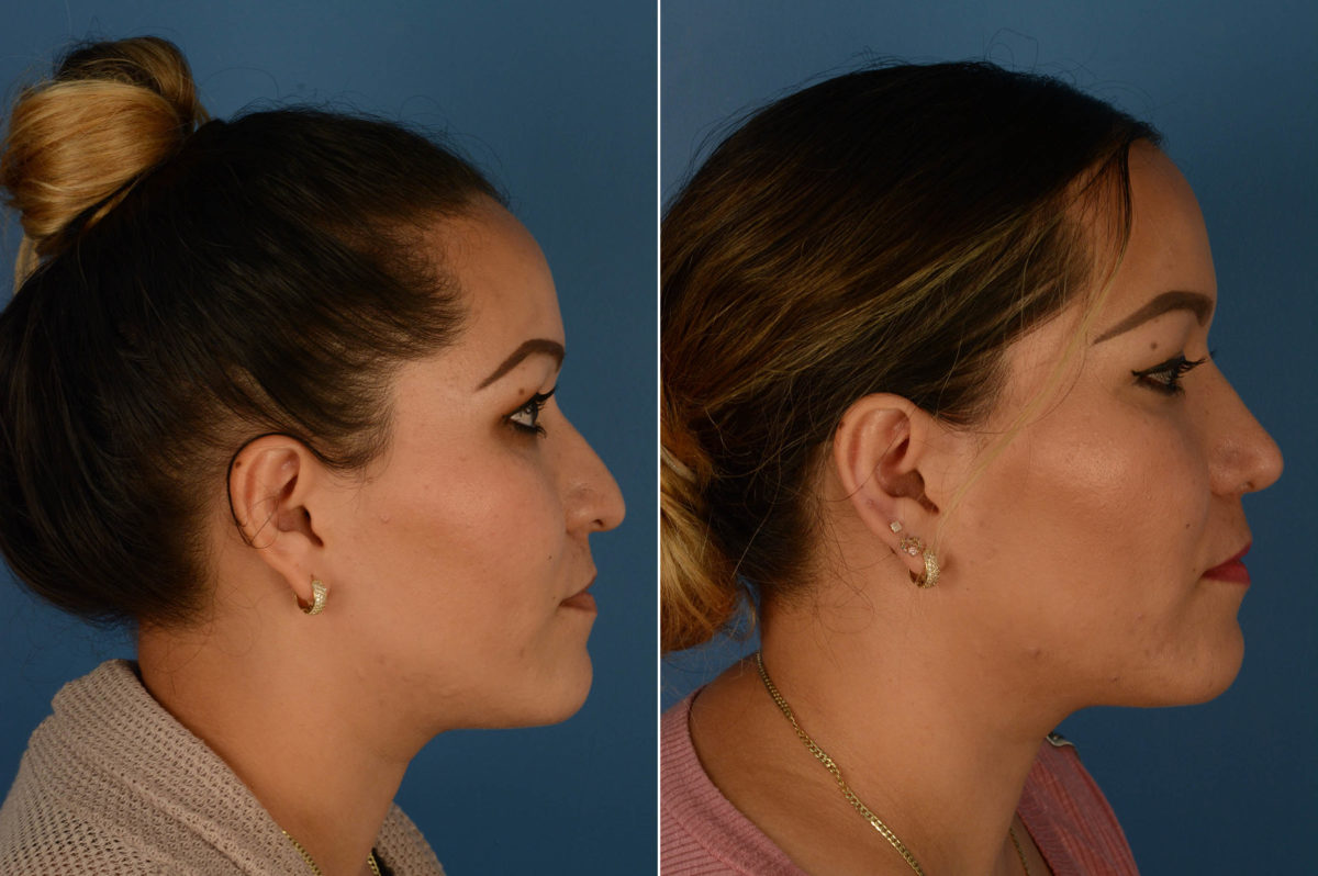 Rhinoplasty Before and After Photos in Naples, FL, Patient 14588