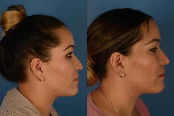 Rhinoplasty Before and After Photos in Naples, FL, Patient 14588