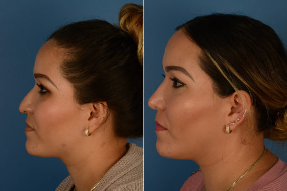 Rhinoplasty Before and After Photos in Naples, FL, Patient 14588