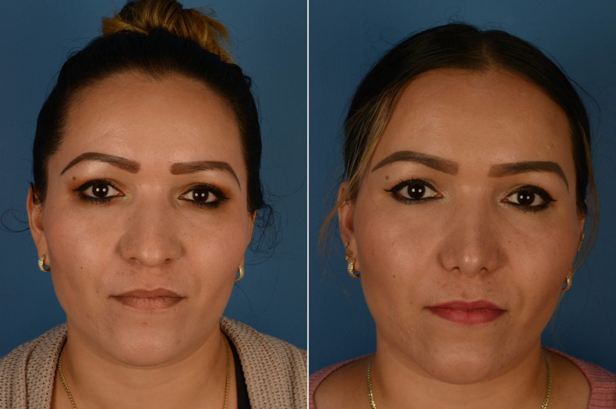 Rhinoplasty Before and After Photos in Naples, FL, Patient 14588