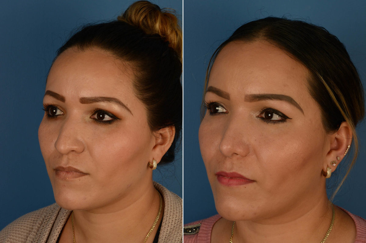 Rhinoplasty Before and After Photos in Naples, FL, Patient 14588