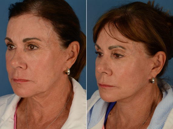 The UpLift™ Lower Face and Neck Lift Before and After Photos in Naples, FL, Patient 14717