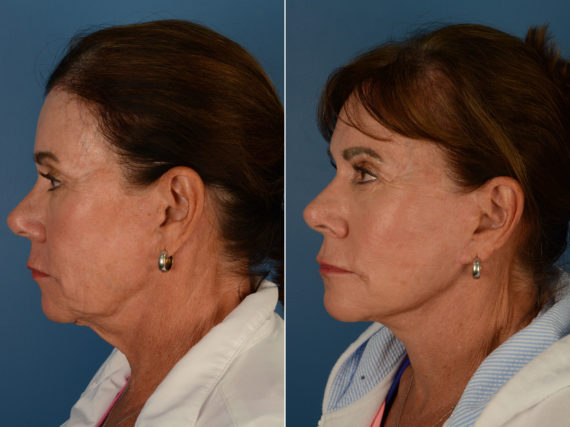 The UpLift™ Lower Face and Neck Lift Before and After Photos in Naples, FL, Patient 14717