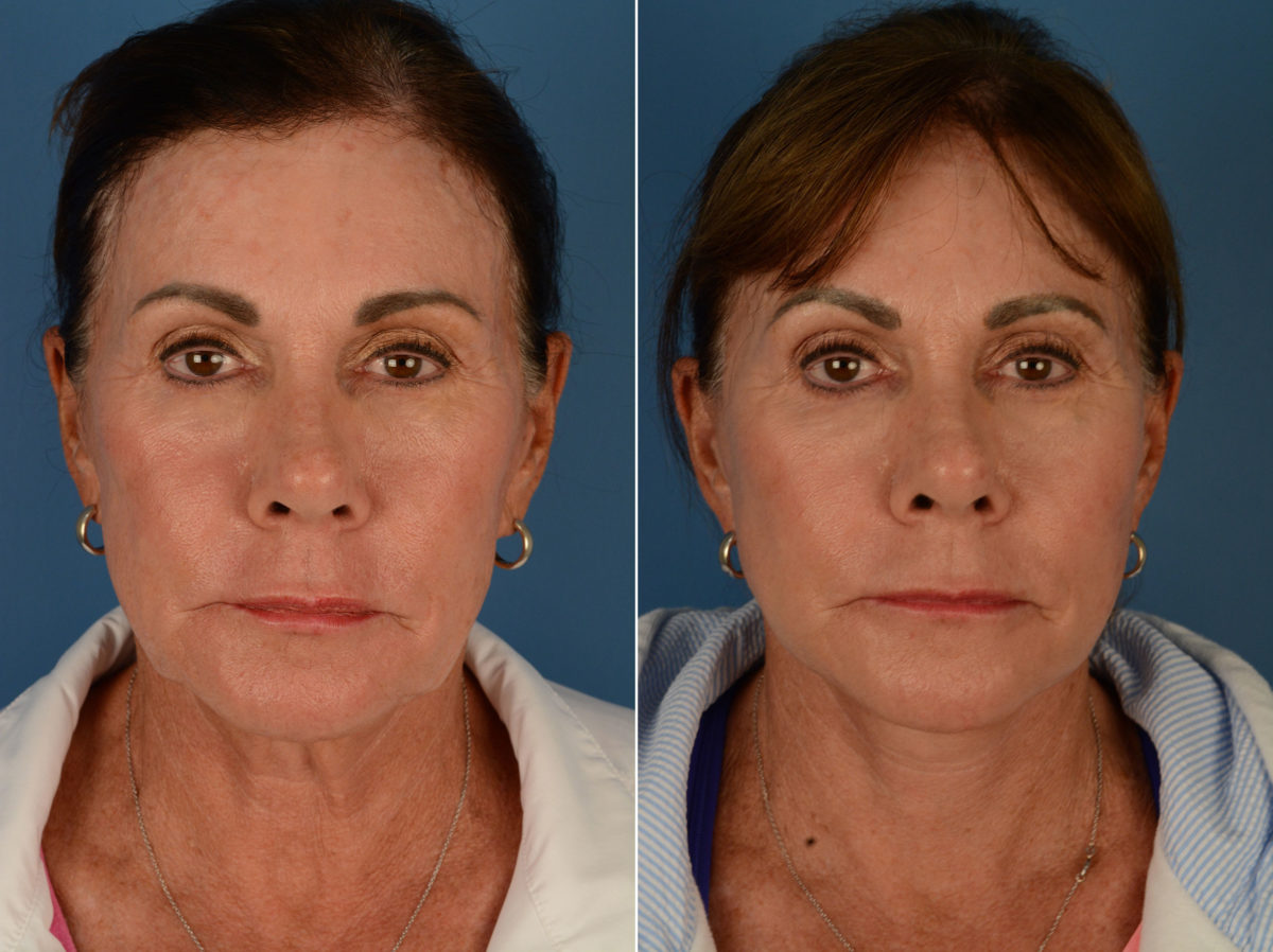 The UpLift™ Lower Face and Neck Lift Before and After Photos in Naples, FL, Patient 14717