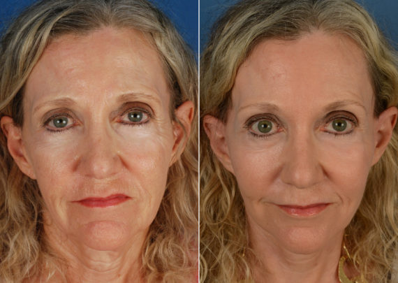 The UpLift™ Lower Face and Neck Lift Before and After Photos in Naples, FL, Patient 11239