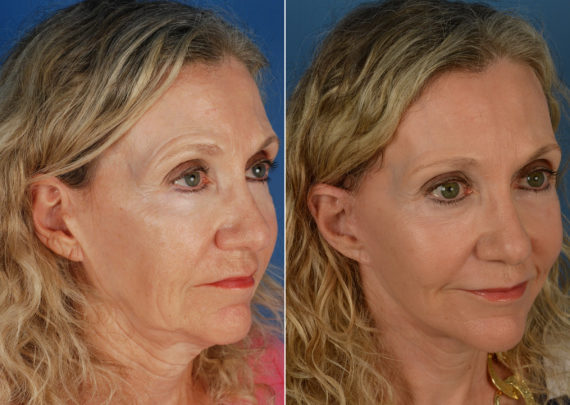 The UpLift™ Lower Face and Neck Lift Before and After Photos in Naples, FL, Patient 11239