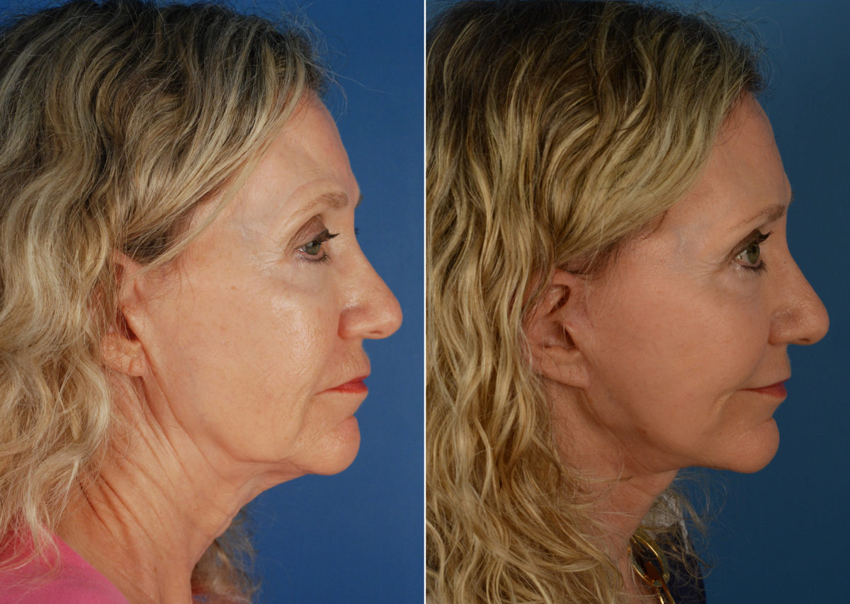 The UpLift™ Lower Face and Neck Lift Before and After Photos in Naples, FL, Patient 11239