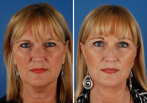 Eyebrow & Forehead Before and After Photos in Naples, FL, Patient 8480