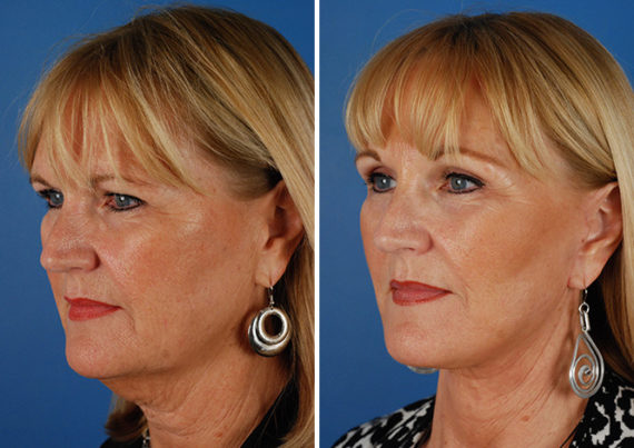 Eyebrow & Forehead Before and After Photos in Naples, FL, Patient 8480