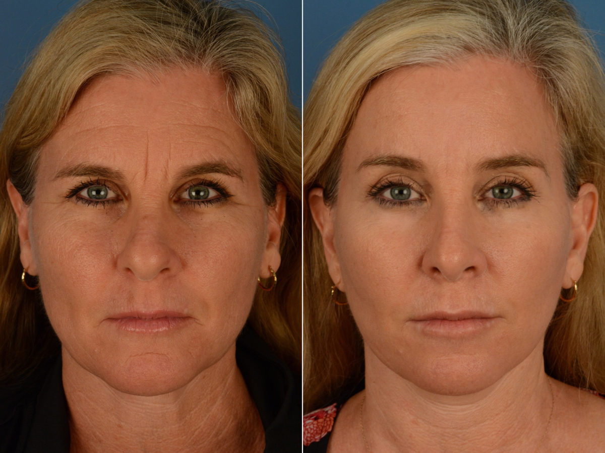 Eyebrow & Forehead Before and After Photos in Naples, FL, Patient 15100