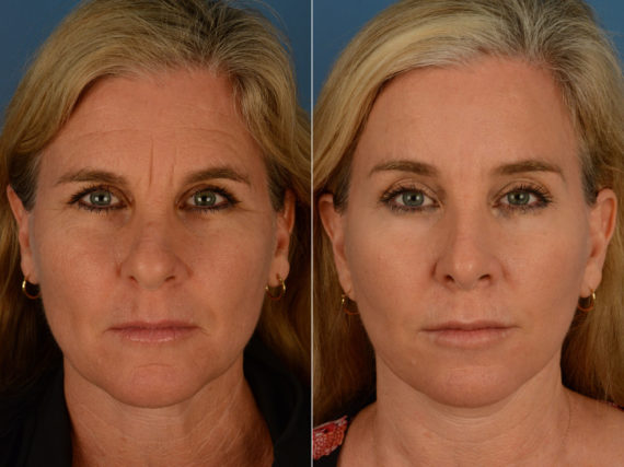 Eyebrow & Forehead Before and After Photos in Naples, FL, Patient 15100