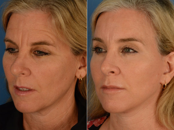 Eyebrow & Forehead Before and After Photos in Naples, FL, Patient 15100