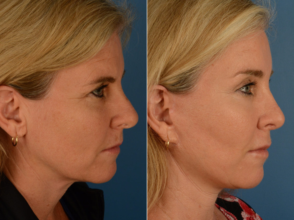 Eyebrow & Forehead Before and After Photos in Naples, FL, Patient 15100
