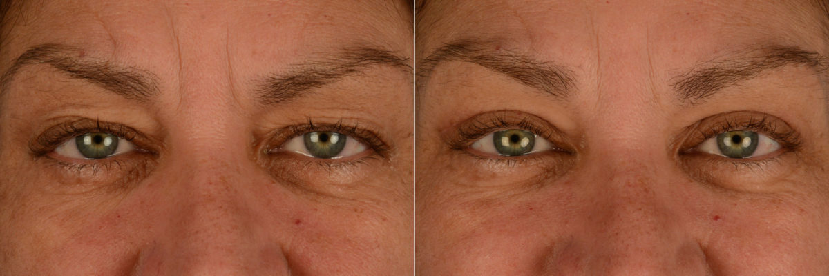 Blepharoplasty Before and After Photos in Naples, FL, Patient 15368