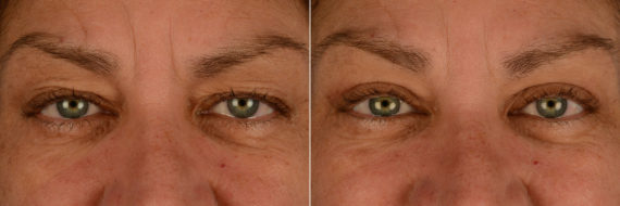 Blepharoplasty Before and After Photos in Naples, FL, Patient 15368