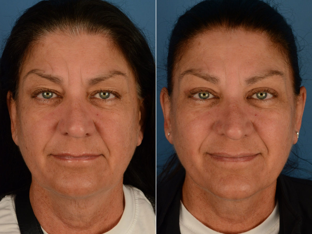 Blepharoplasty Before and After Photos in Naples, FL, Patient 15368