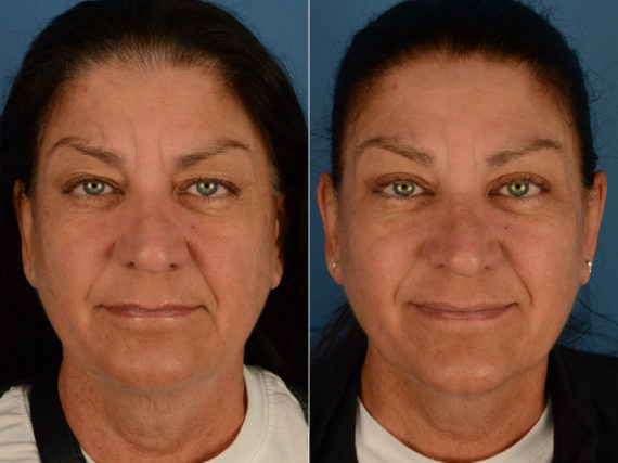 Blepharoplasty Before and After Photos in Naples, FL, Patient 15368
