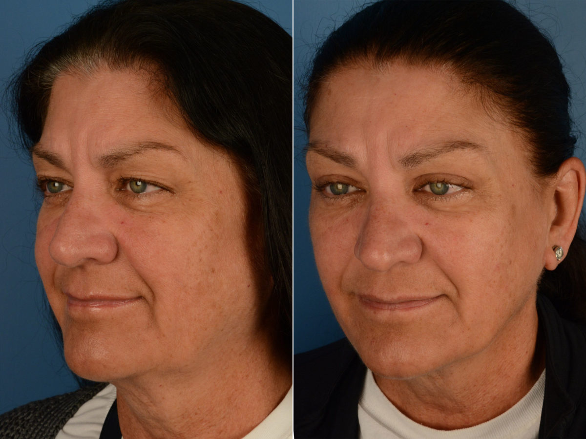 Blepharoplasty Before and After Photos in Naples, FL, Patient 15368