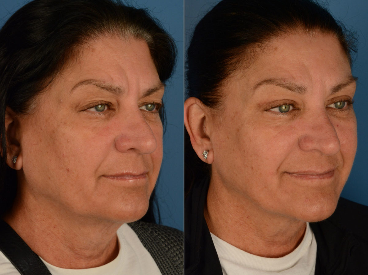 Blepharoplasty Before and After Photos in Naples, FL, Patient 15368