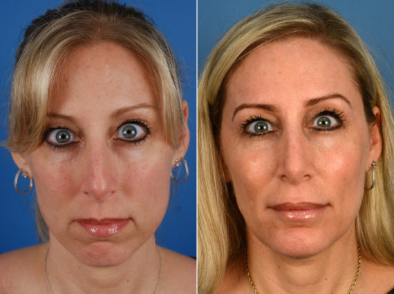 Rhinoplasty Before and After Photos in Naples, FL, Patient 11224