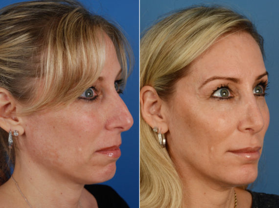 Rhinoplasty Before and After Photos in Naples, FL, Patient 11224