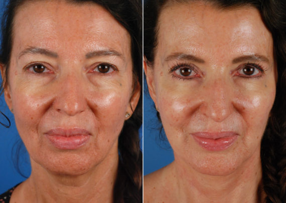 The UpLift™ Lower Face and Neck Lift Before and After Photos in Naples, FL, Patient 10636