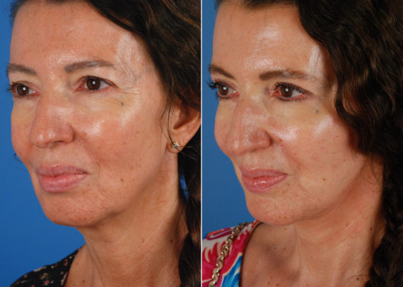 The UpLift™ Lower Face and Neck Lift Before and After Photos in Naples, FL, Patient 10636