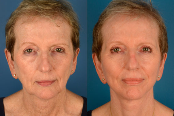 The UpLift™ Lower Face and Neck Lift Before and After Photos in Naples, FL, Patient 16216