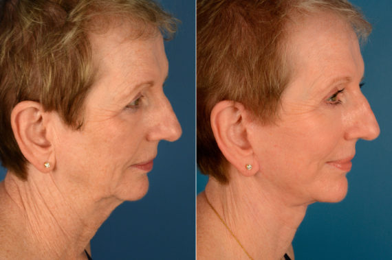 The UpLift™ Lower Face and Neck Lift Before and After Photos in Naples, FL, Patient 16216