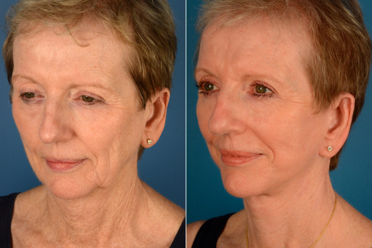 The UpLift™ Lower Face and Neck Lift Before and After Photos in Naples, FL, Patient 16216