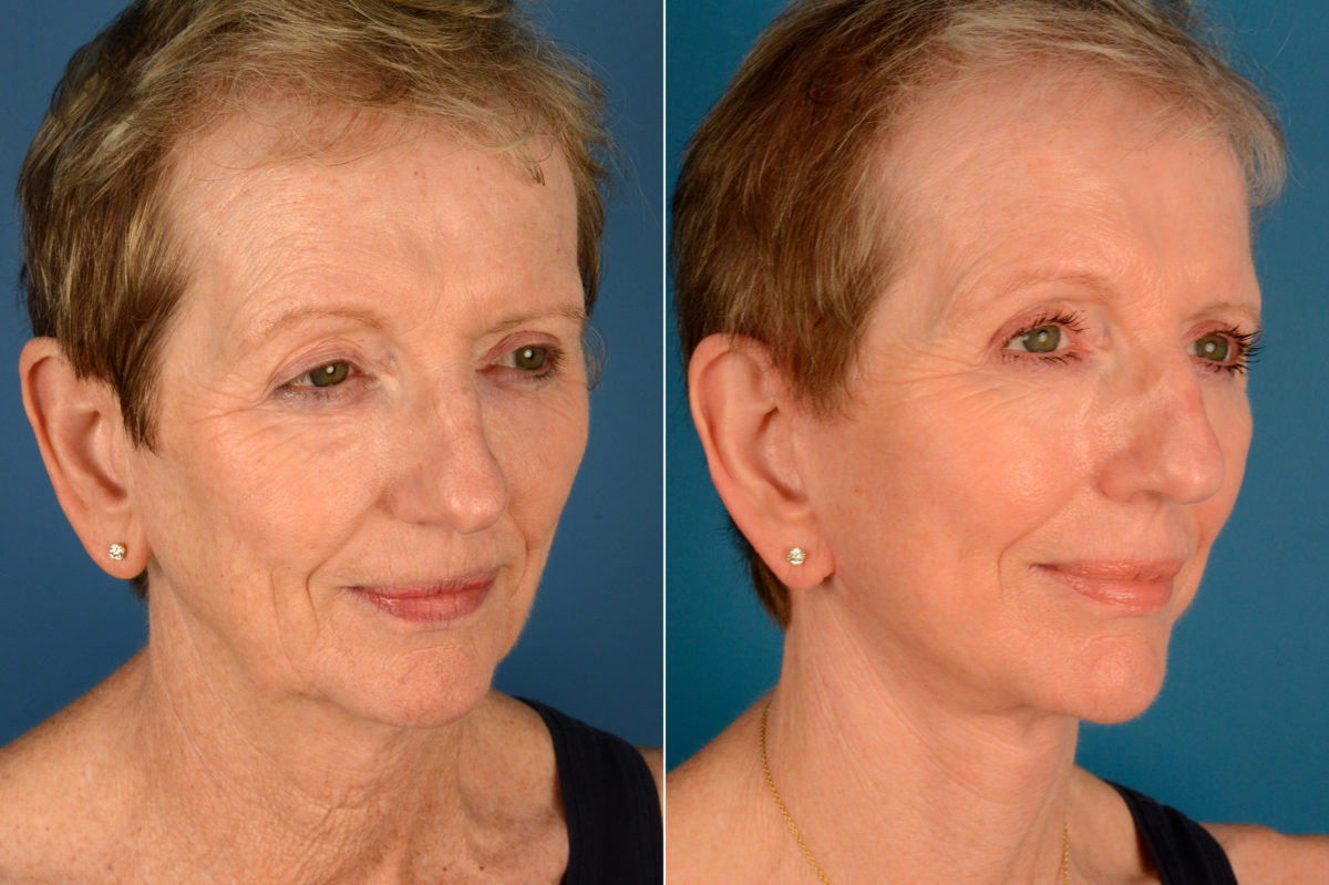 The UpLift™ Lower Face and Neck Lift Before and After Photos in Naples, FL, Patient 16216