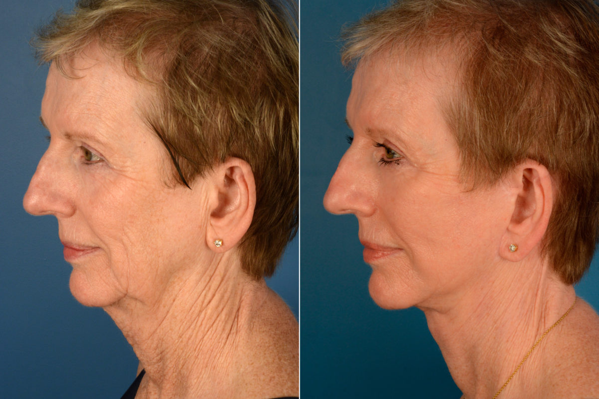 The UpLift™ Lower Face and Neck Lift Before and After Photos in Naples, FL, Patient 16216