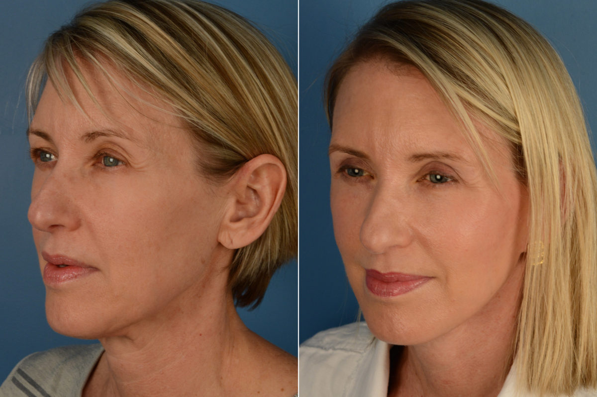 The UpLift™ Lower Face and Neck Lift Before and After Photos in Naples, FL, Patient 16233