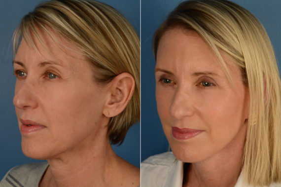 The UpLift™ Lower Face and Neck Lift Before and After Photos in Naples, FL, Patient 16233