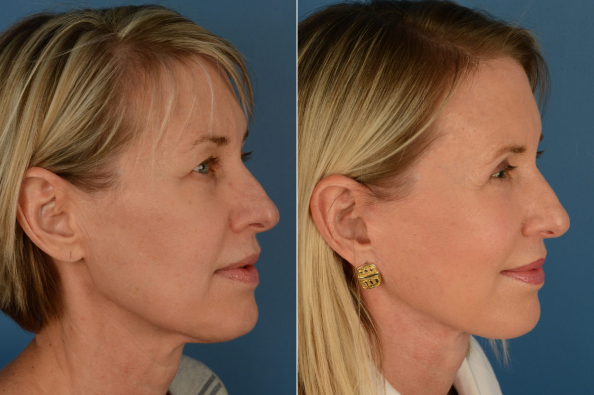 The UpLift™ Lower Face and Neck Lift Before and After Photos in Naples, FL, Patient 16233