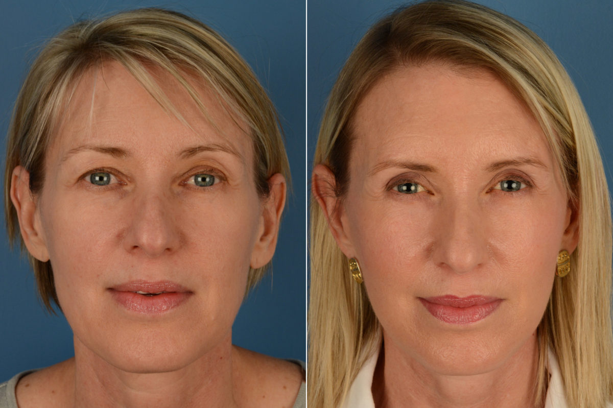 The UpLift™ Lower Face and Neck Lift Before and After Photos in Naples, FL, Patient 16233