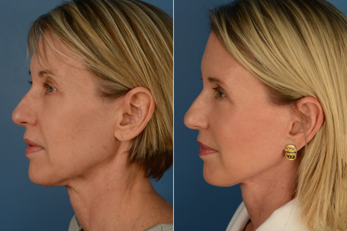 The UpLift™ Lower Face and Neck Lift Before and After Photos in Naples, FL, Patient 16233