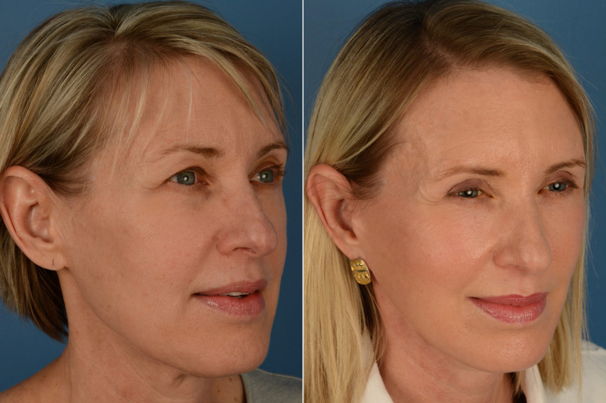 The UpLift™ Lower Face and Neck Lift Before and After Photos in Naples, FL, Patient 16233